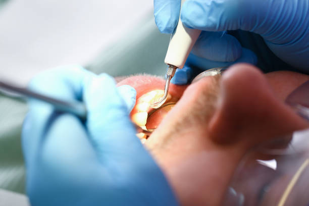 Best Dentist for Tooth Abscess  in Marion, TX