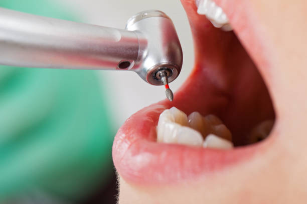 Best Emergency Tooth Extraction  in Marion, TX